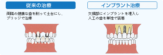 前歯一本欠損の場合のイメージ図