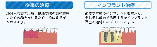 臼歯部から歯が欠損している場合、イメージ