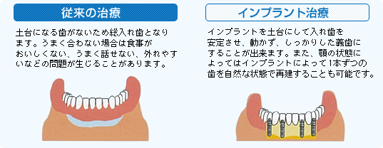 完全に歯がない場合、イメージ